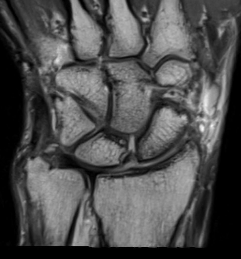 SL mri