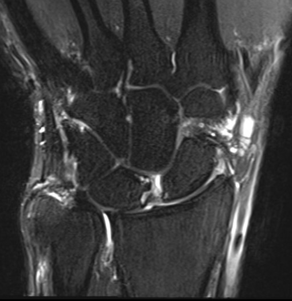 SL mri