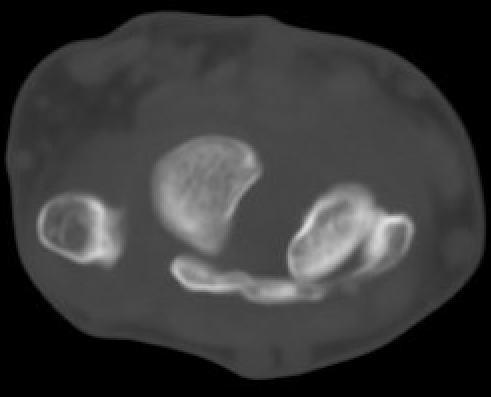 CT SL