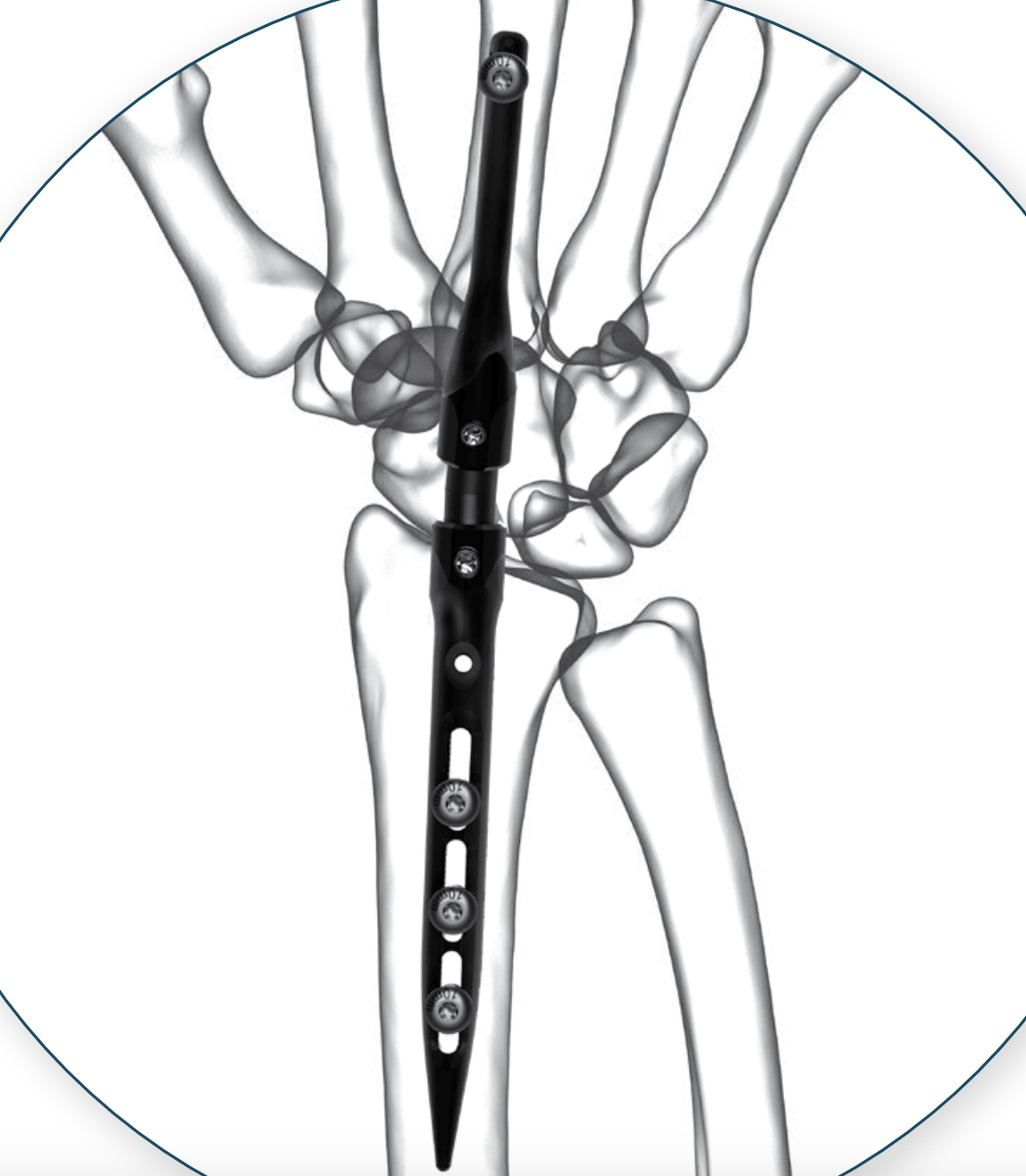 wrist nail