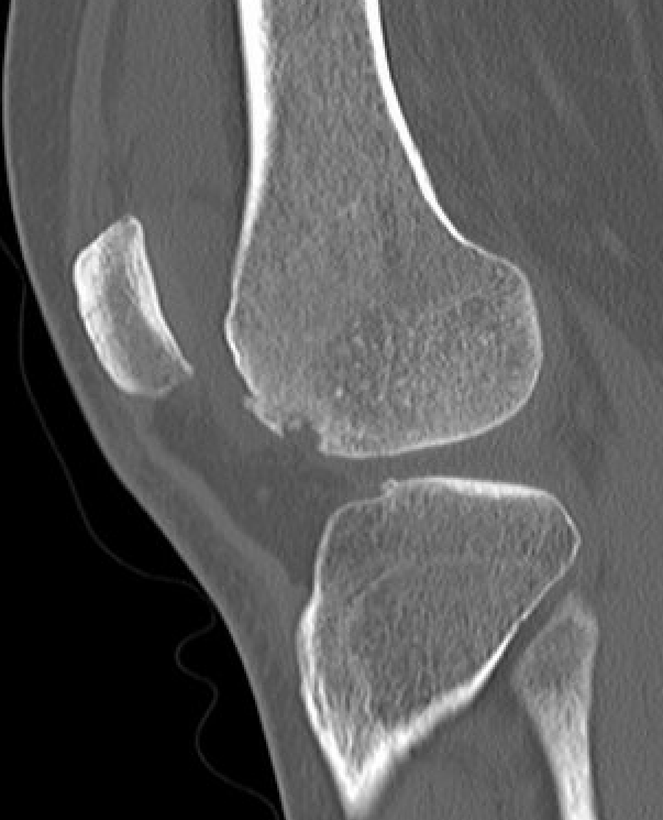 CT PFJ