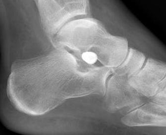 Arthroereisis