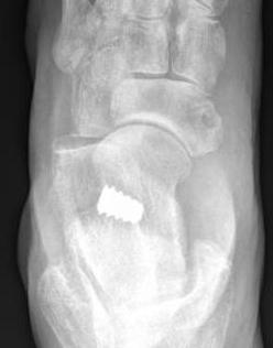 Arthro