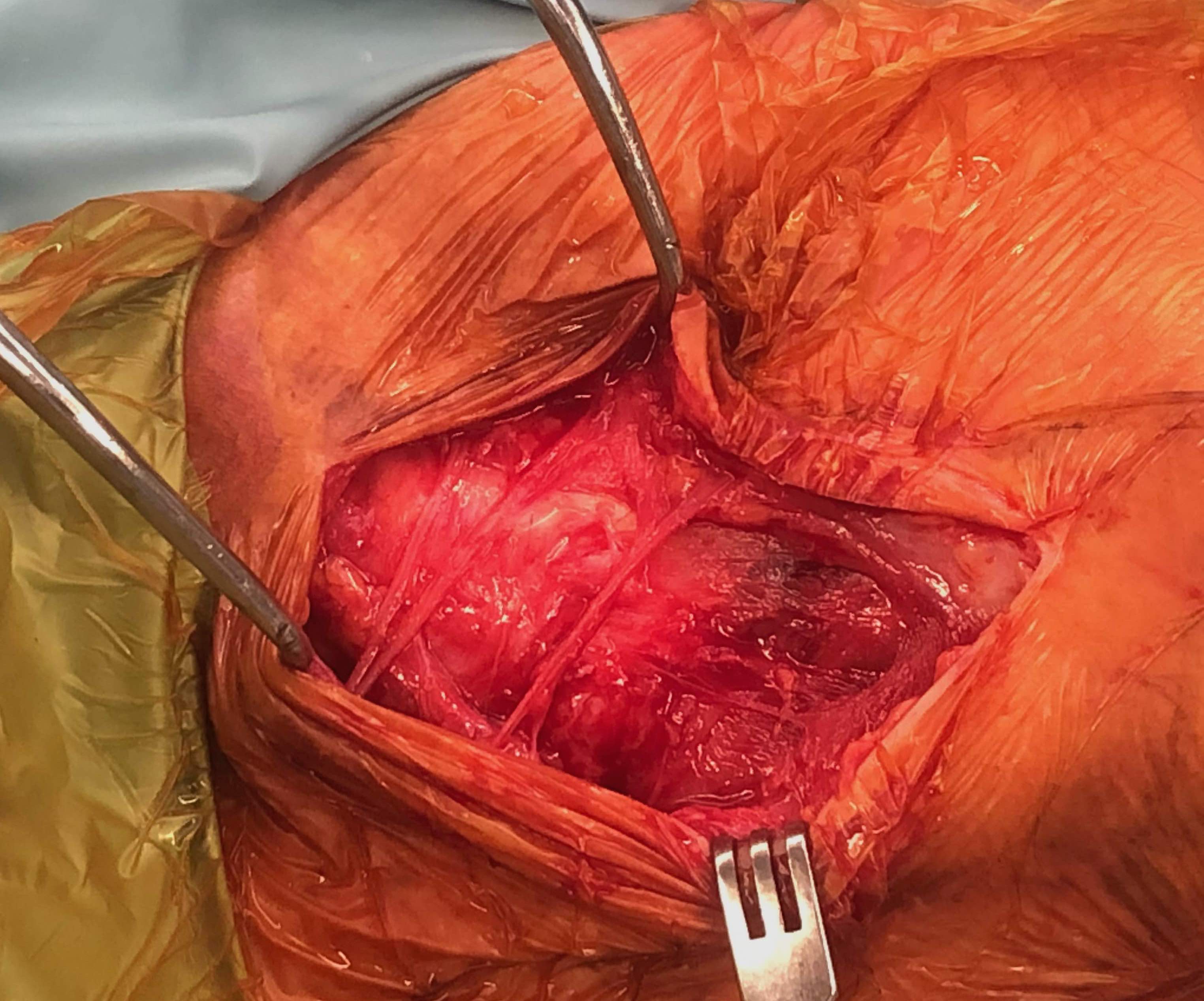 supraclav nerves