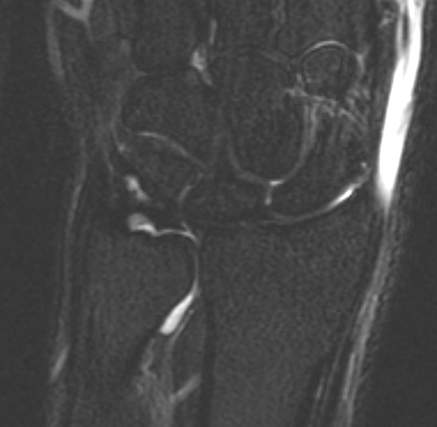 radial sided tear