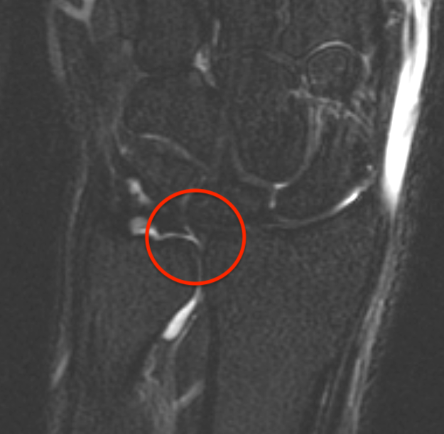radial sided