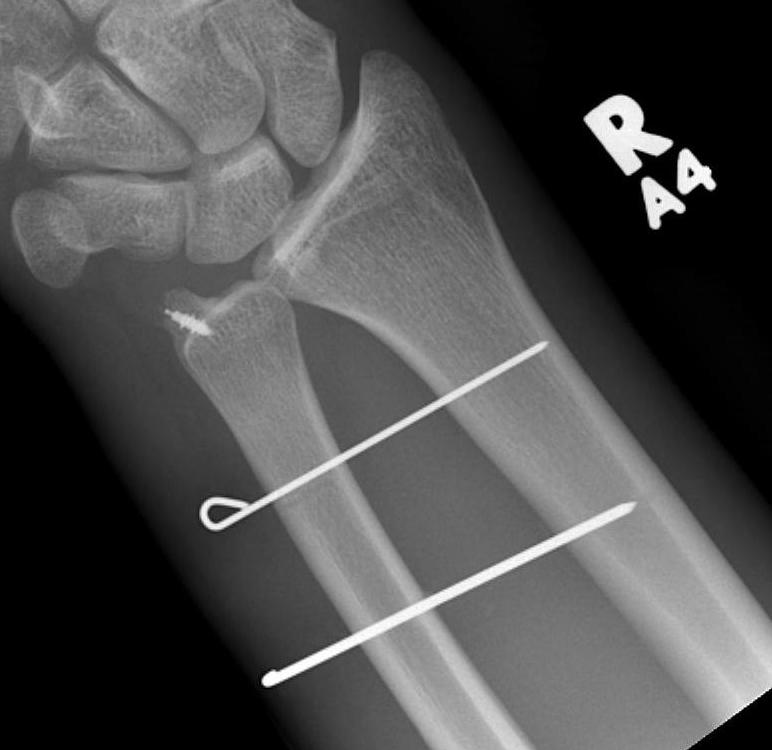 TFCC repair