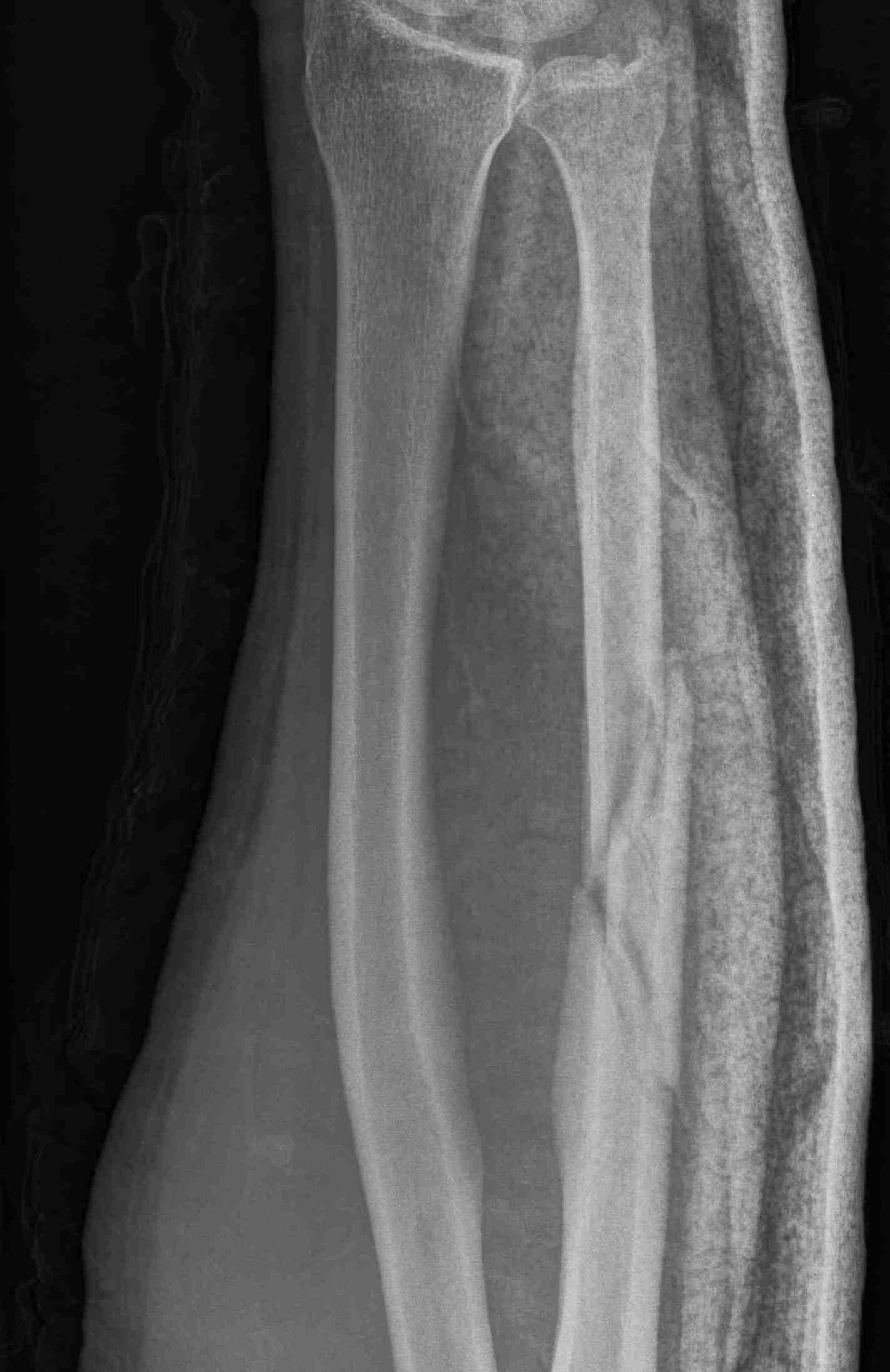ulna