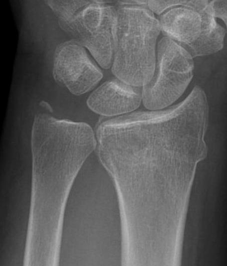 ulna styloid