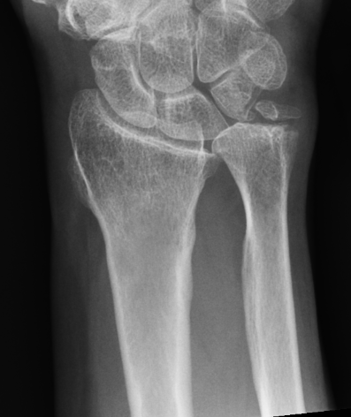 ulna short