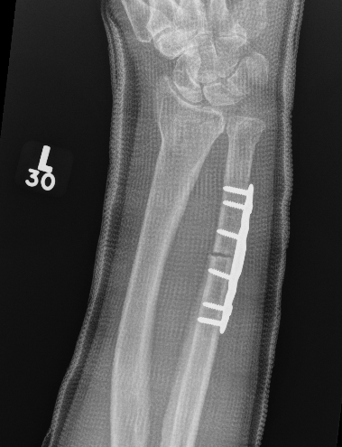 ulna short