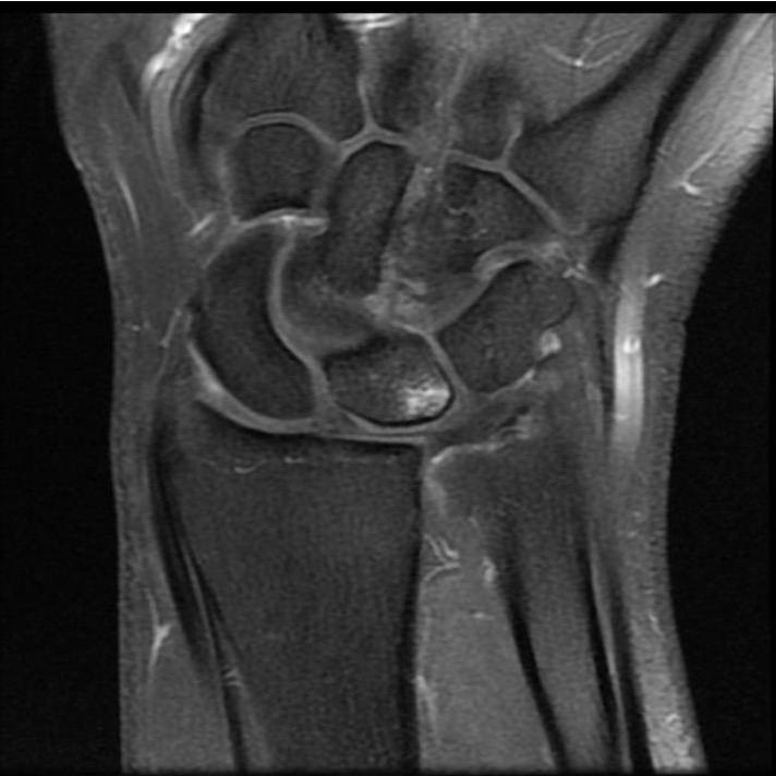ulnocarpal abutment