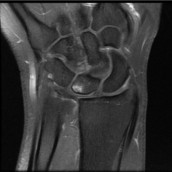 ulnocarpal abutment