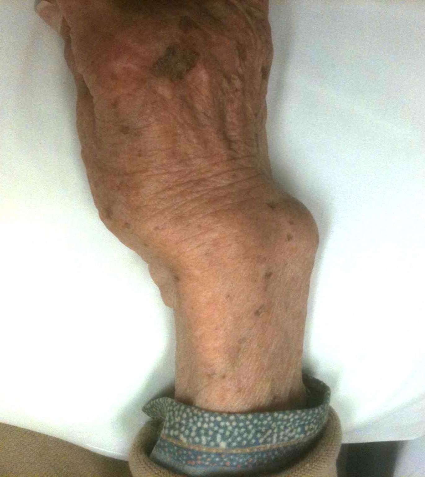 RA wrist