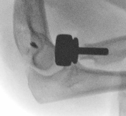 radial head