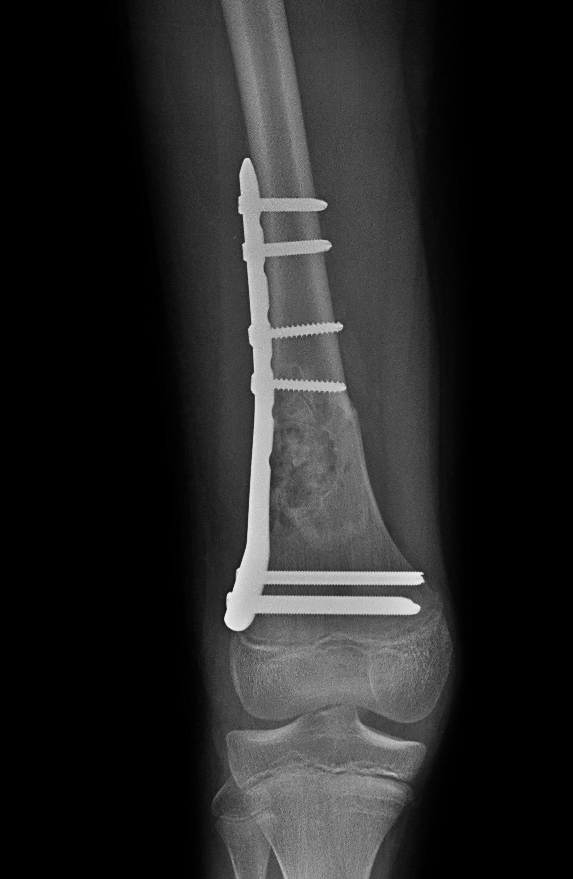 Dis femur