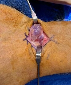 ganglion
