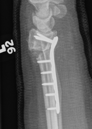 osteotomy