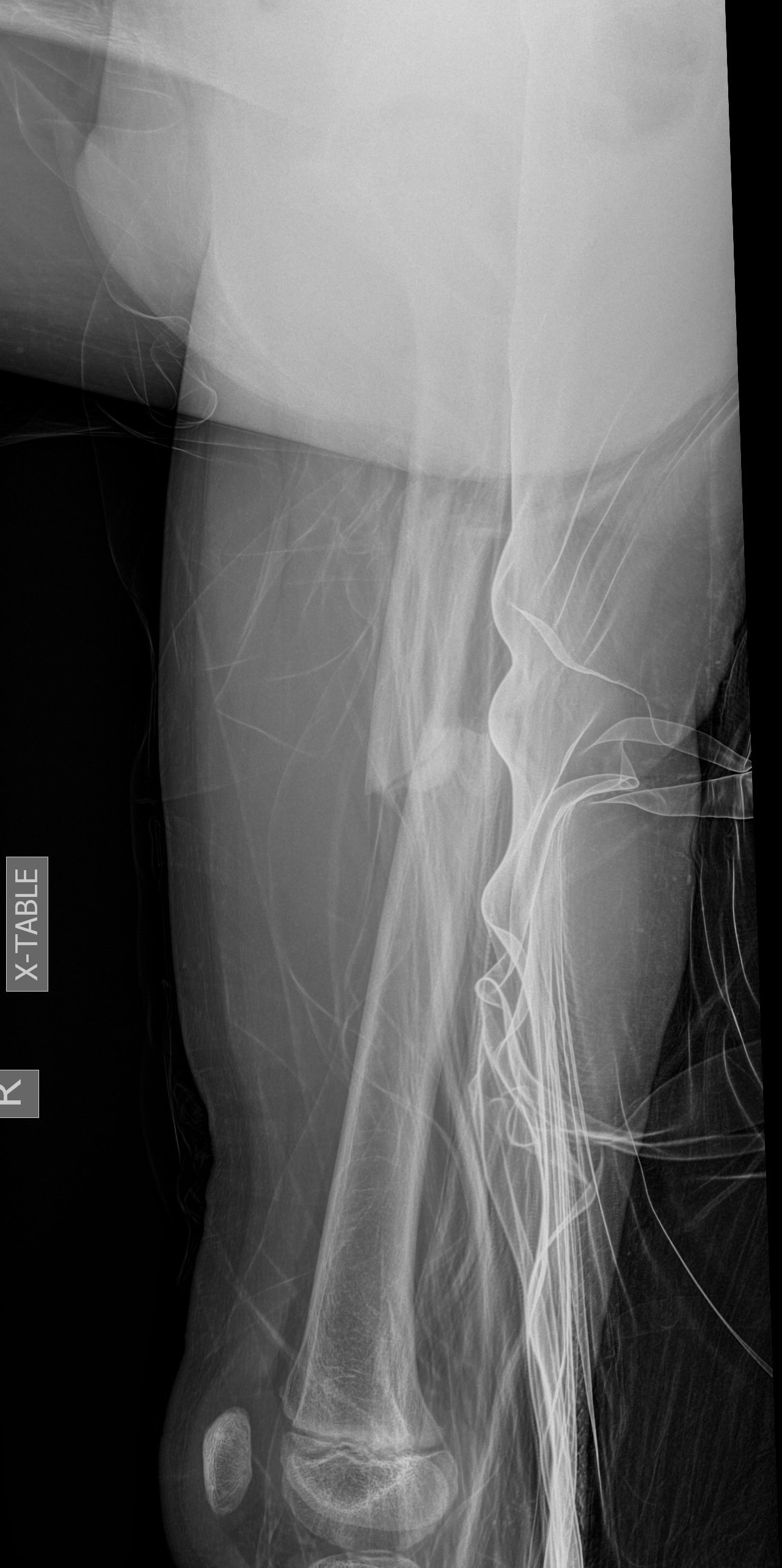 femur