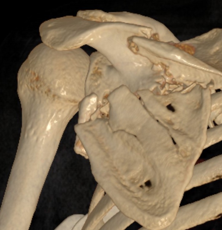 medial displacement