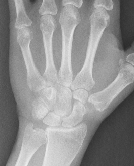 trapeziectomy