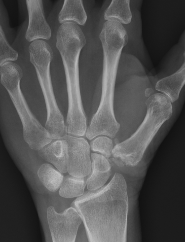 trapeziectomy