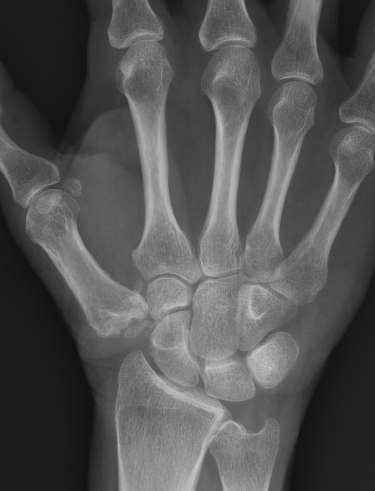 Trapeiectomy